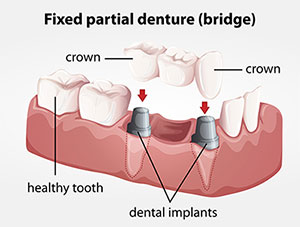 Dr. Patel, Dentist Jacksonville, FL, Dental Bridges and restoration offered