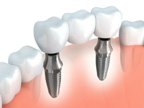 Dr. Patel, Cosmetic Dentistry, Jacksonville, FL Dentist, Dental Implants